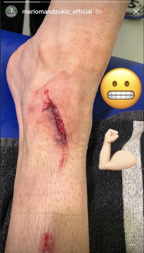 受伤,曼朱基奇赛后晒伤口