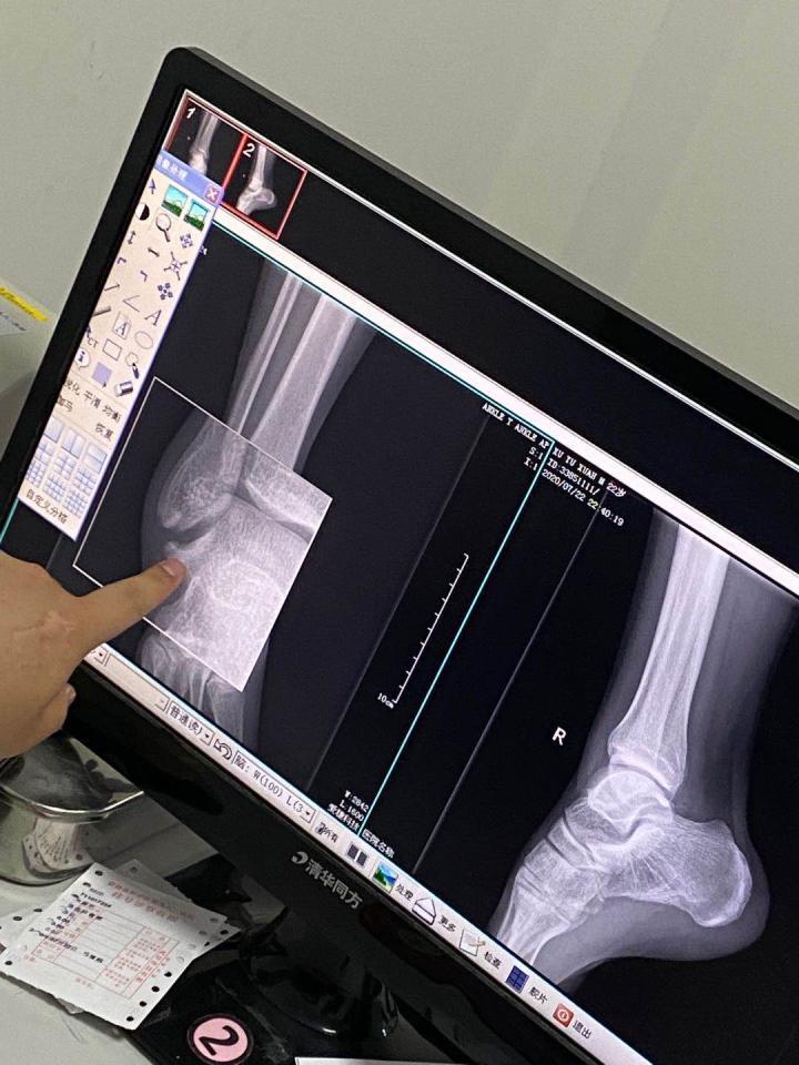 一个半月以前的撕脱性骨折,现在可以借助拐杖走路了