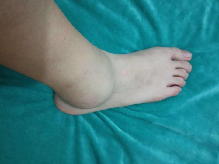 扭到脚 具体是啥忘了拄拐两个月[流泪狗头]