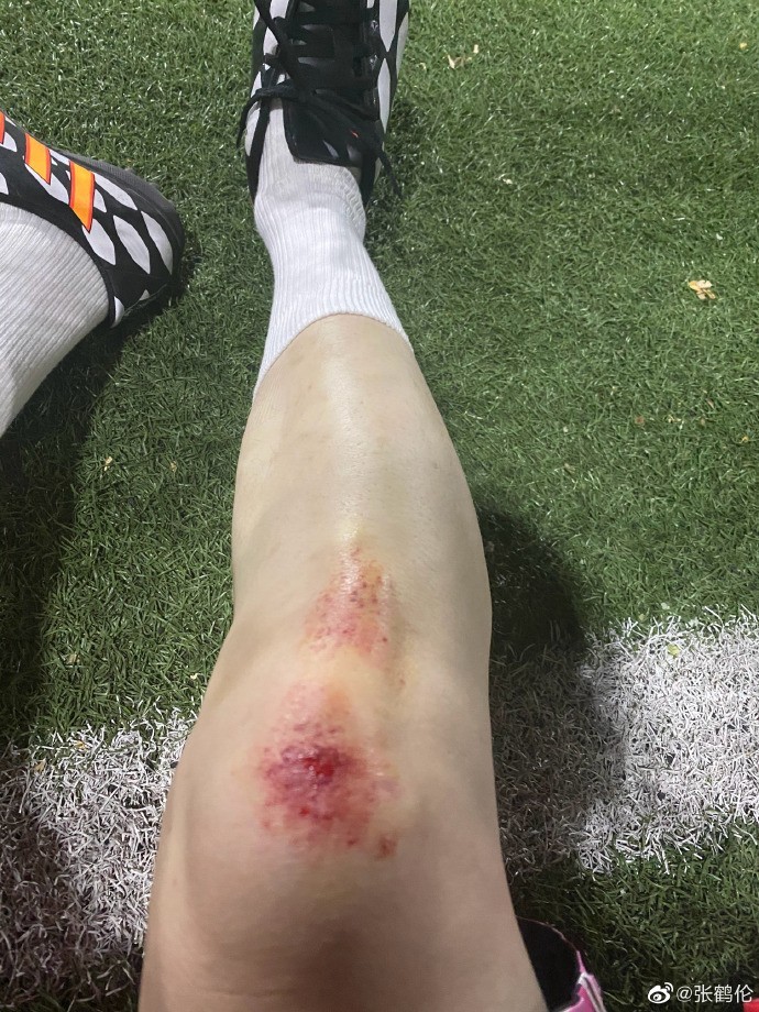 德云社演员张鹤伦踢球最后一场球又受伤了真悲催