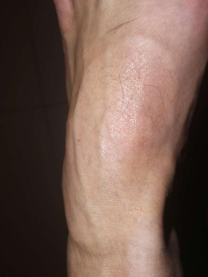 今天打篮球的时候不小心,脚扭到了,脚背肿了一块,.