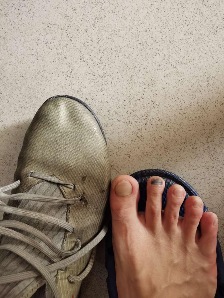 脚趾甲黑了有没有好兄弟知道这是为什么[流泪狗头].