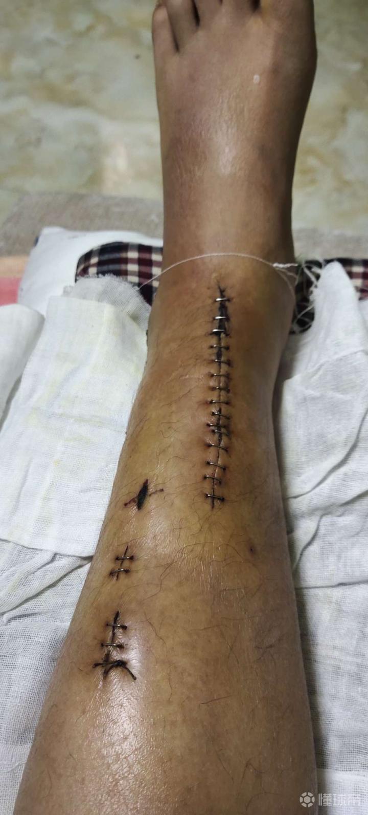 清明节左腿胫腓骨下端粉碎性骨折4月7号做了手术