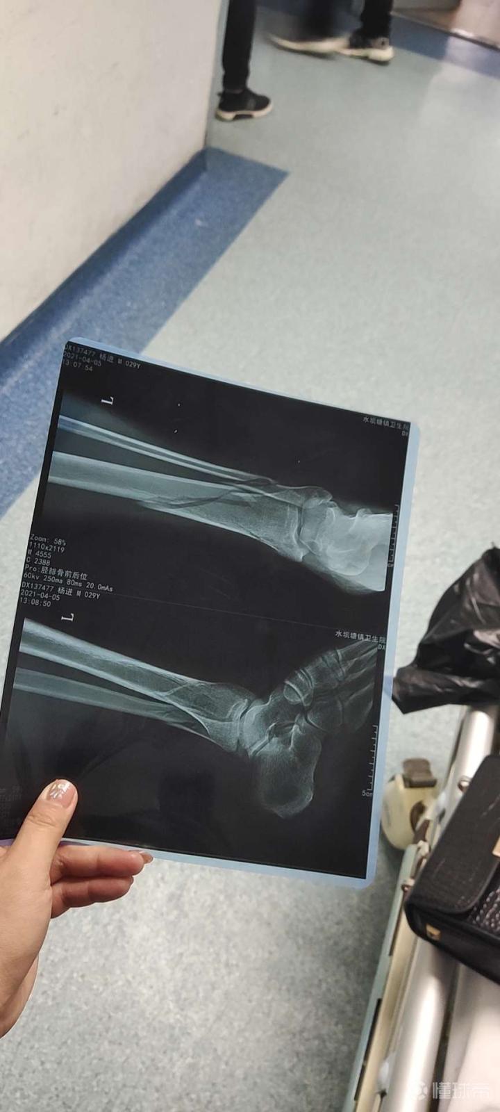 清明节左腿胫腓骨下端粉碎性骨折4月7号做了手术