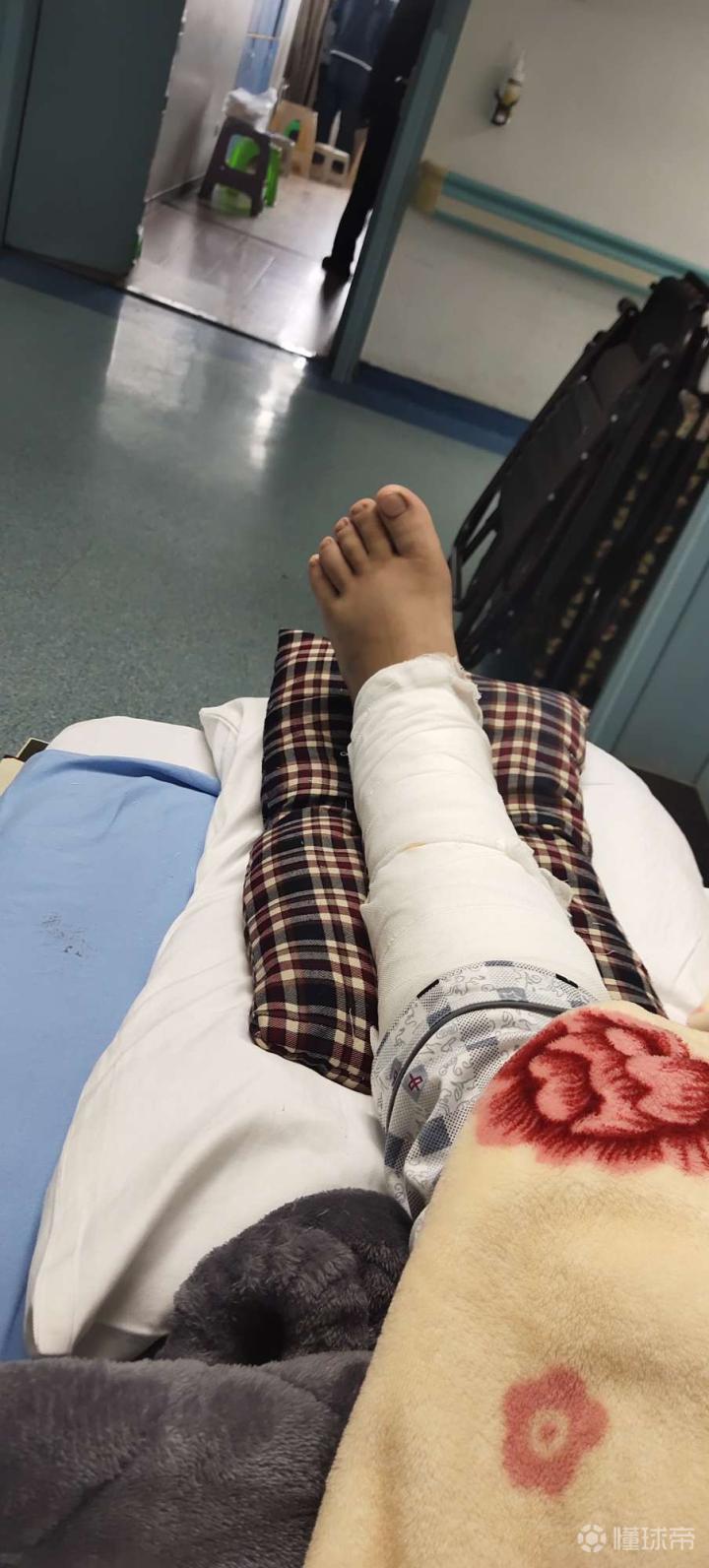 清明节左腿胫腓骨下端粉碎性骨折4月7号做了手术