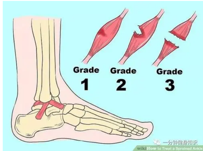 肌肉拉伤怎么办